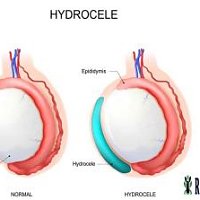 Hydrocele Problem: Causes, Symptoms & Treatment
