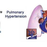 How does Sildenafil work in Pulmonary hypertension?
