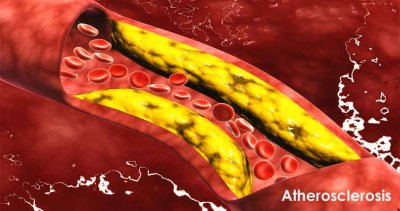 Atherosclerosis - Causes, Symptoms and Treatment