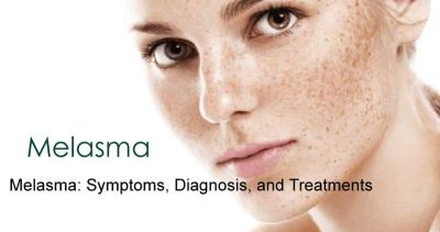 Melasma: Symptoms, Diagnosis, and Treatments