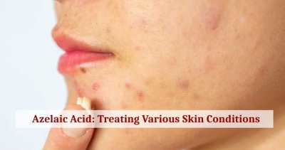 Azelaic Acid: How It Is Beneficial In Treating Various Skin Conditions