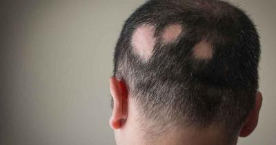 How does finasteride work in treating hair loss?
