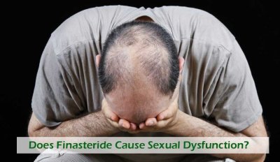Does Finasteride Cause Sexual Dysfunction?
