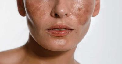 Hyperpigmentation and its Treatment