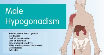 Hypogonadism and Its Causes, Symptoms, Treatment