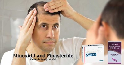 Minoxidil vs Finasteride: Do Both Really Work?