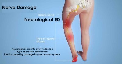 Nerve Damage and erectile dysfunction: All You Need To Know